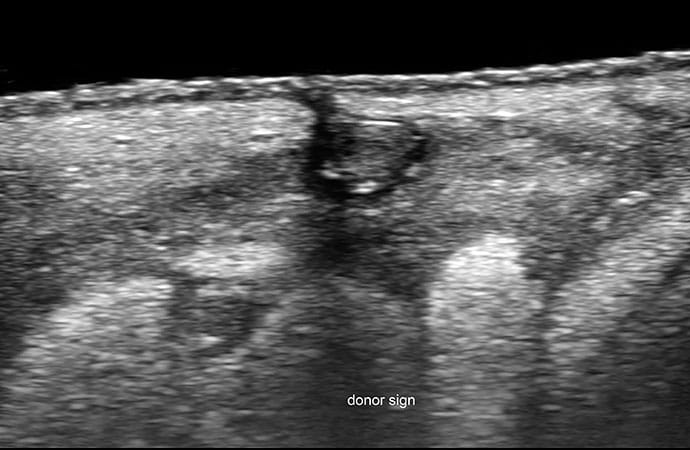 photo of Donor sign: A ballooned hair follicle protruding into a fluid collection or a tunnel.