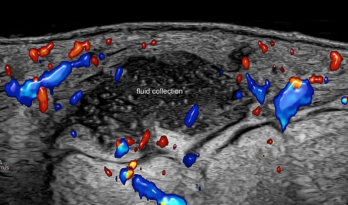 photo of Fluid collection: hypoechoic or anechoic dermal and/or hypodermal sac-like structure