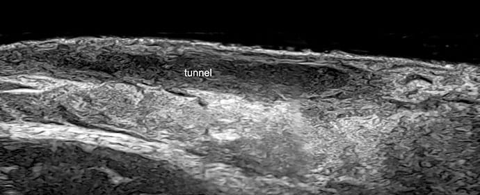 photo of Tunnel: hypoechoic or anechoic band-like dermal and/or hypodermal structures.
