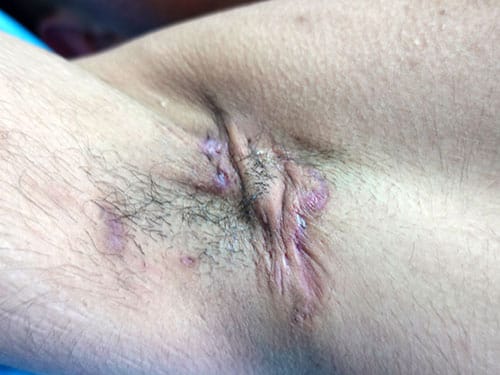 photo of hidradenitis suppurativa lesion affecting the right axillary region