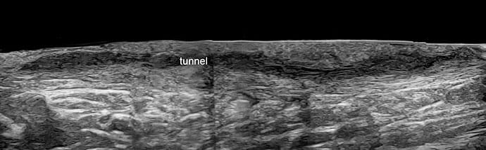 photo of A tunnel: Hypoechoic or anechoic band-like dermal and/or hypodermal structures.
