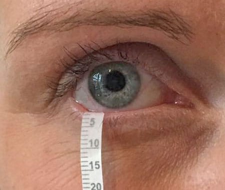 photo of Schirmer test
