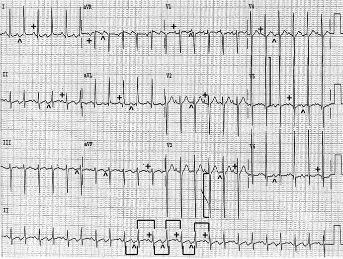 ECG : une hypertension non contrôlée