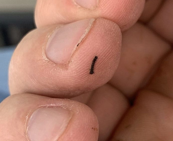 photo of insect bites