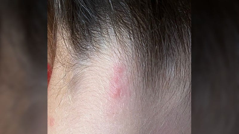 Diagnosing and Treating Insect Bites: Tips for Dermatologists