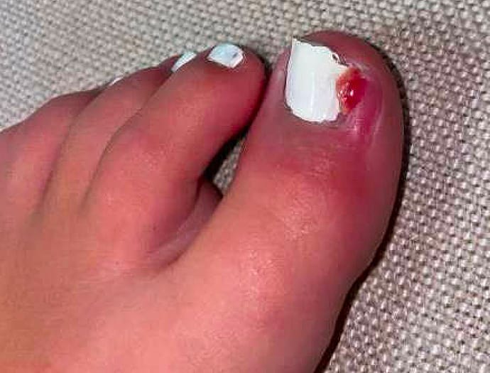 Running Into Trouble: Painful Toe Mystery in a Teen Athlete