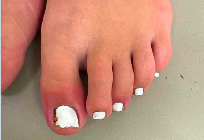 Running Into Trouble: Painful Toe Mystery in a Teen Athlete