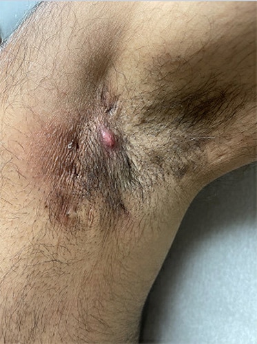photo of Mild hidradenitis suppurativa