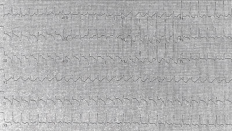 ECG Challenge: Could It Be Another Heart Attack?