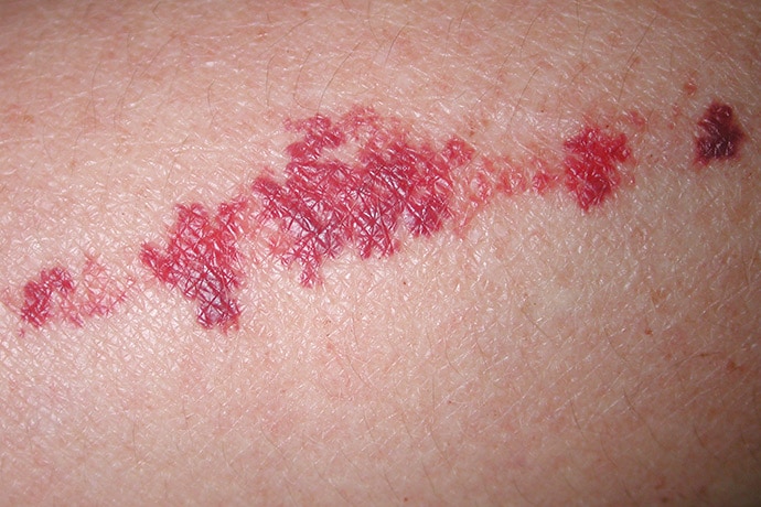 photo of Actinic senile purpura