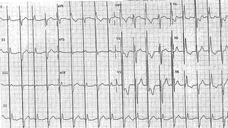 ECG Challenge: New Beats With a Pacemaker
