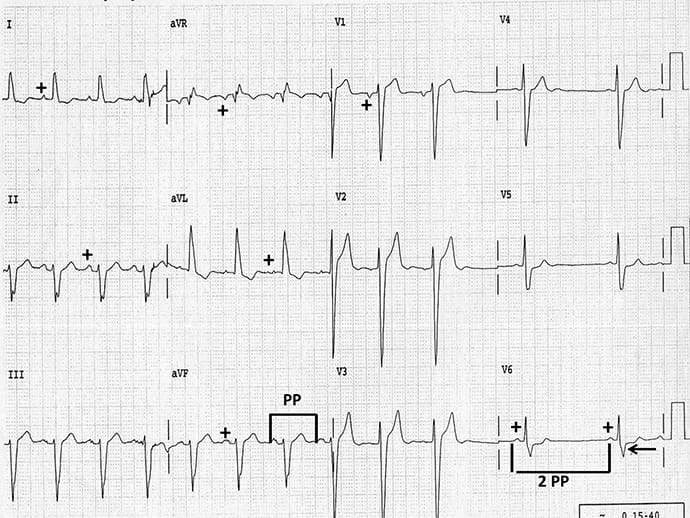 ECG Challenge: Irregular Pulse in a Hypertensive Patient