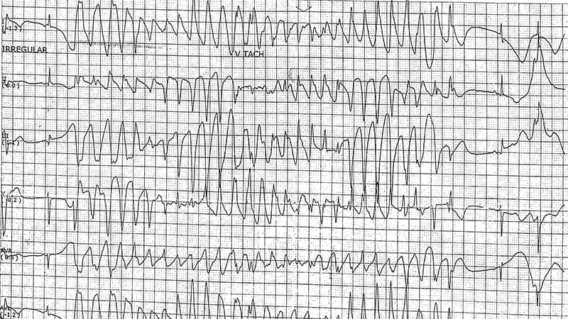 ECG Challenge: Feeling Lightheaded After Methadone Overdose