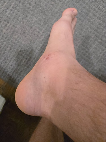 photo of Ankle