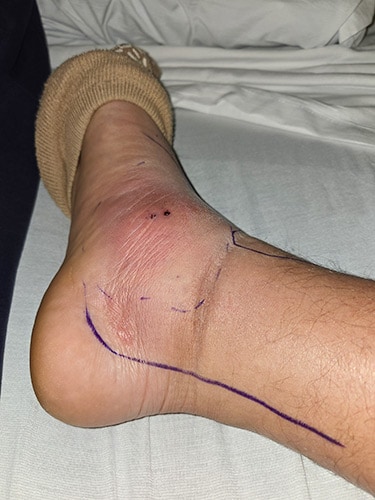 photo of Ankle