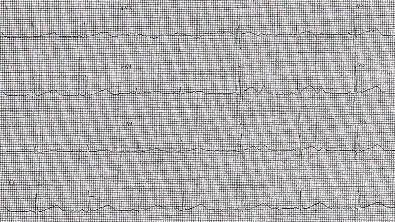 ECG Challenge: Does This Pattern Run in the Family?