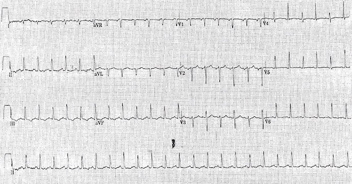 photo of CABG