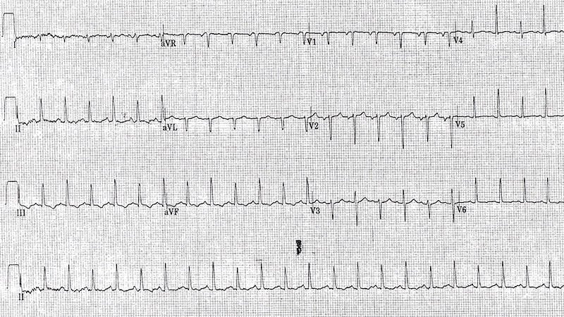 ECG Challenge: Rapid Heart Rate and Chest Discomfort After CABG