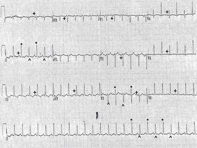 photo of CABG