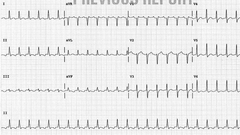 ECG Challenge: What's Causing This Patient's Palpitations?