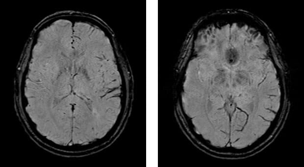 29-Year-Old Man With Sudden-Onset Aphasia and Left-Arm Weakness