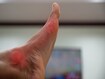 photo of gout