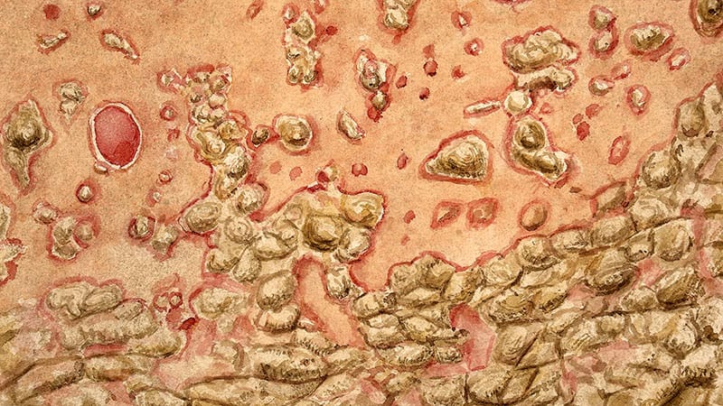 Fast Five Quiz: Severe Psoriasis Treatments