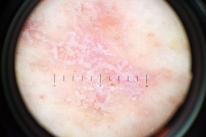 Papular Rash on the Trunk