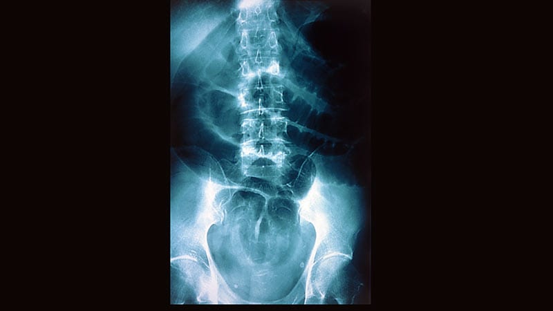 A 53-Year-Old Woman With Sudden-Onset Dysphonia and Paresis