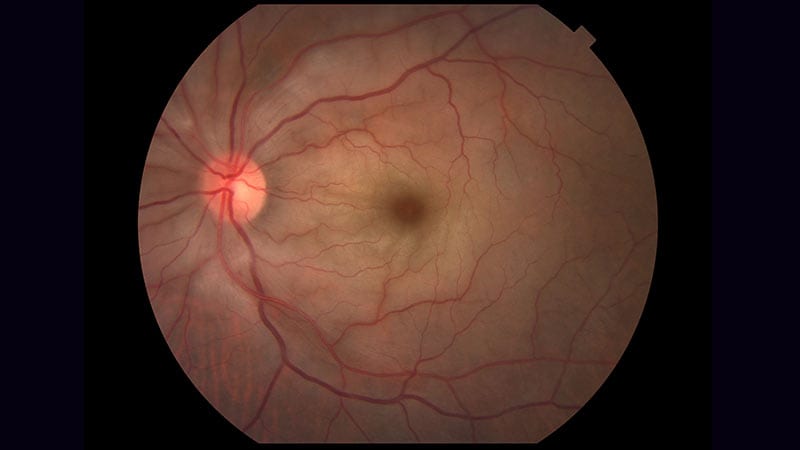 Sudden Vision Loss in a 72-Year-Old Man