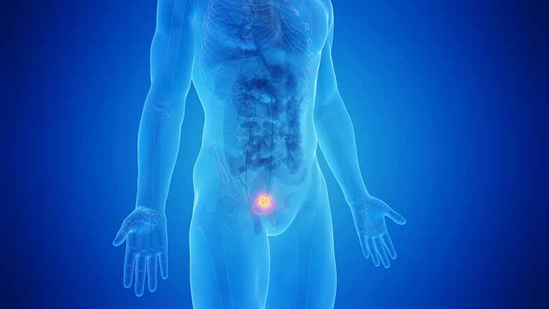 Q&A: Bladder Cancer Treatment Challenges