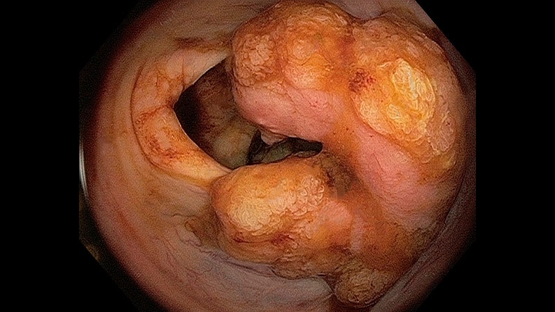 Fall: Ein Mann, der kurz nach Beginn seiner Chemotherapie unerwartet stirbt