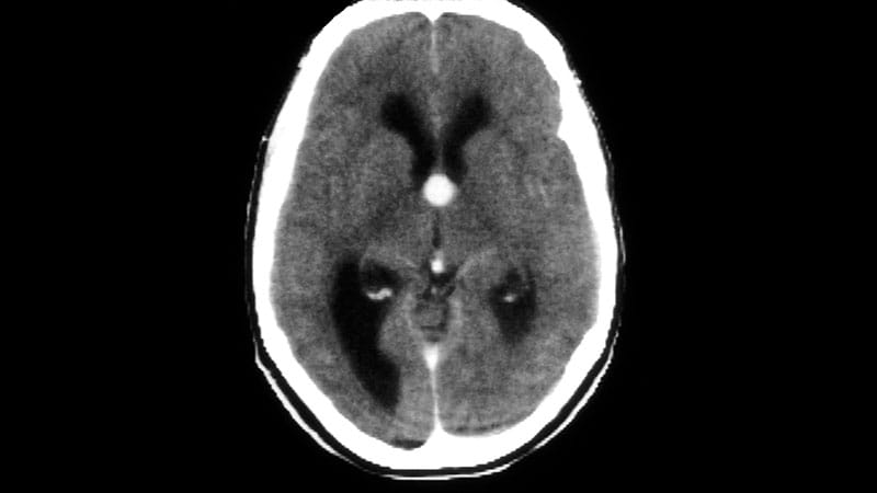 Caso clínico: Ciclista adolescente con visión doble y marcha inestable