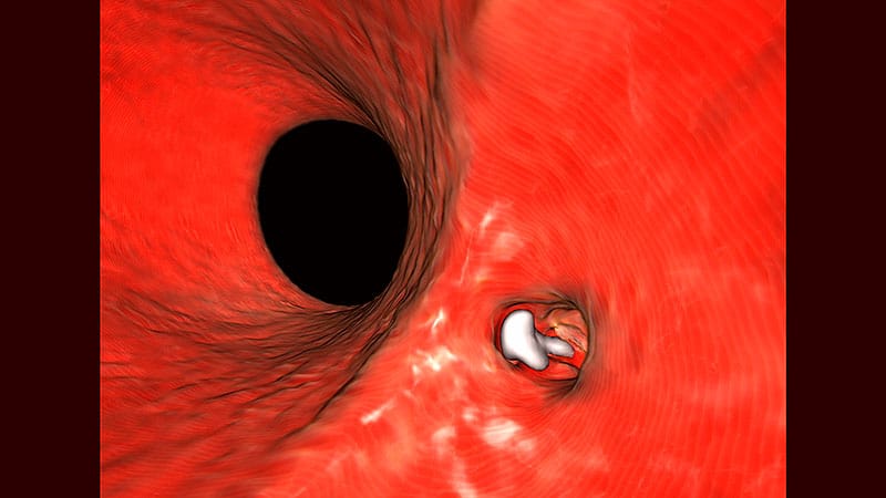 In Two Trials, Balloons Found As Good As IVL But Less Costly for Calcified Coronary Lesions