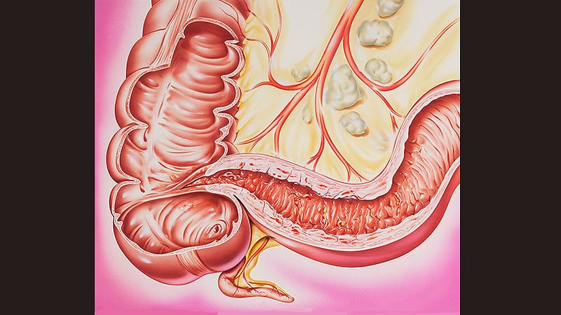 Enfermedad de Crohn: 4 actualizaciones claves de las guías