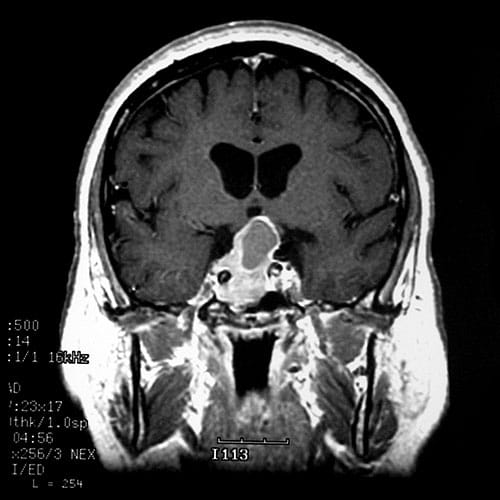 Postmenopausal Woman With Photophobia and a Severe Headache