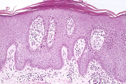 Pruritic Rash in a Woman With Chronic Inflammatory Disease