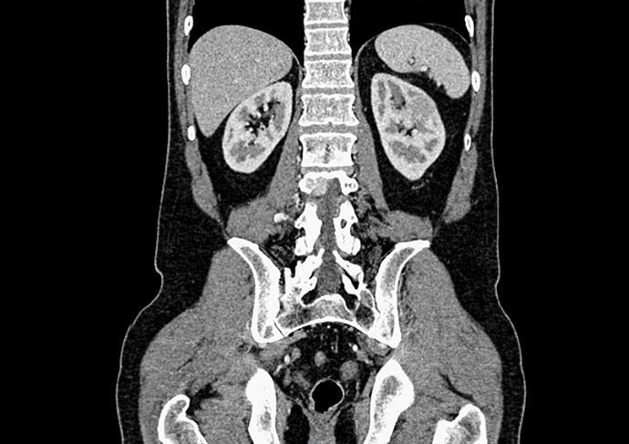 A 60-Year-Old Woman With 3 Months of Abdominal Discomfort