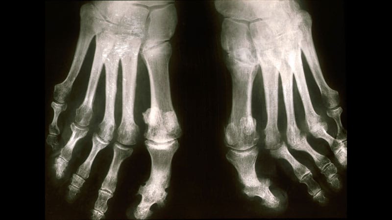 Fast Five Quiz: Differential Diagnosis for PsA