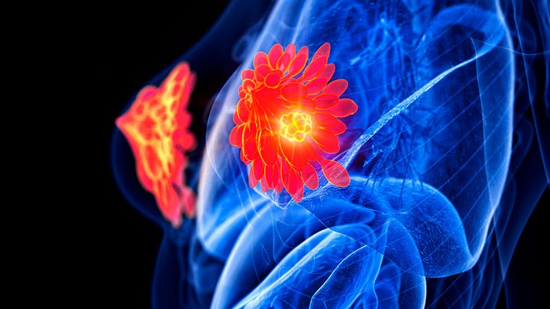 Fast Five Quiz: Oligometastatic Breast Cancer