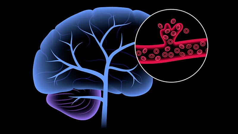 Fast Five Quiz: Stroke Anticoagulation and Prophylaxis