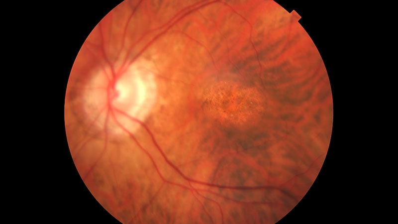 Novel Geographic Atrophy Measure Aligns With Vision Clarity