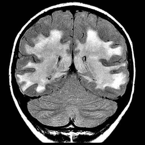Leg Stiffness and Near-Falls in a 27-Year-Old Former Athlete