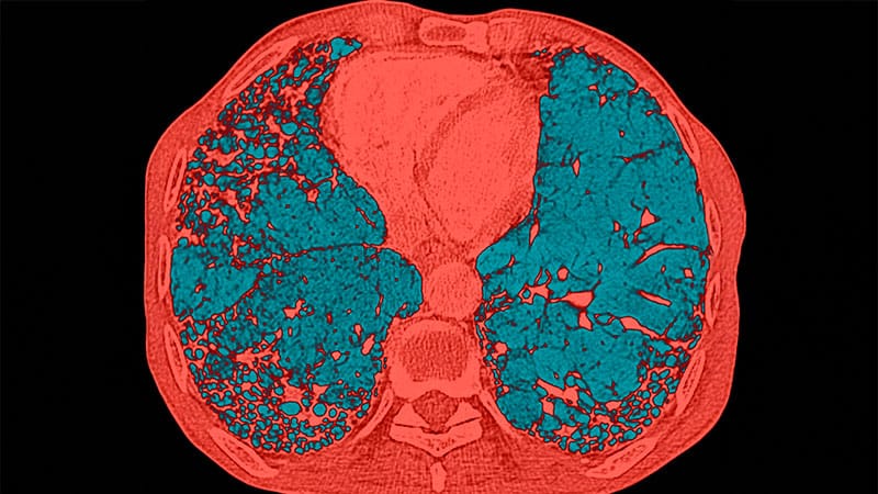 Teste Rápido: Fibrose pulmonar progressiva