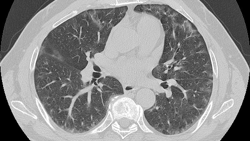 Pembrolizumab Favored Over Chemo for Pulmonary AEs
