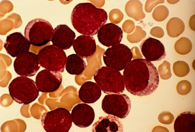 Low SOS Rate Seen with InO + Defibrotide Before HSCT