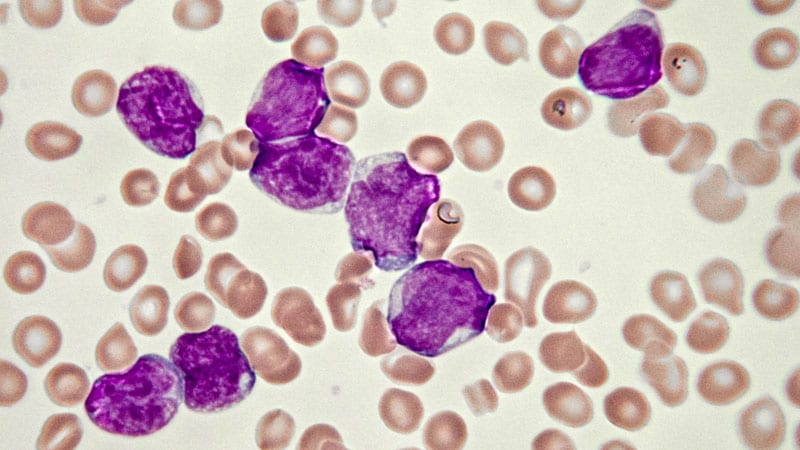 CAR T for B-ALL: Game Changer for Young Patients?