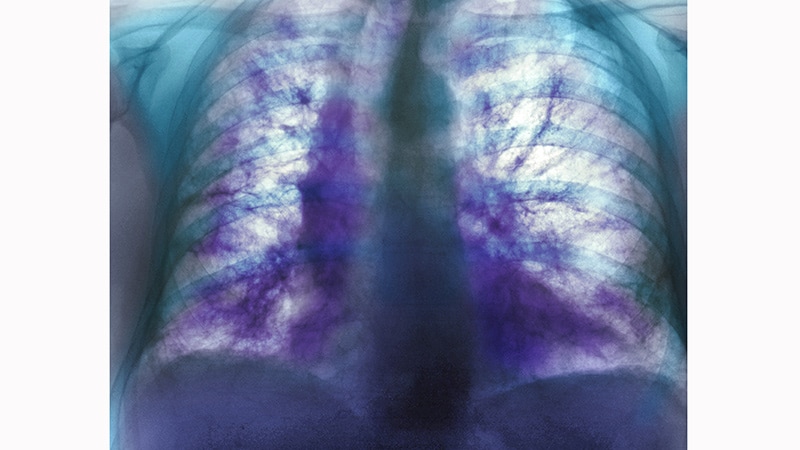 Nerandomilast May Slow Down Progressive Pulmonary Fibrosis
