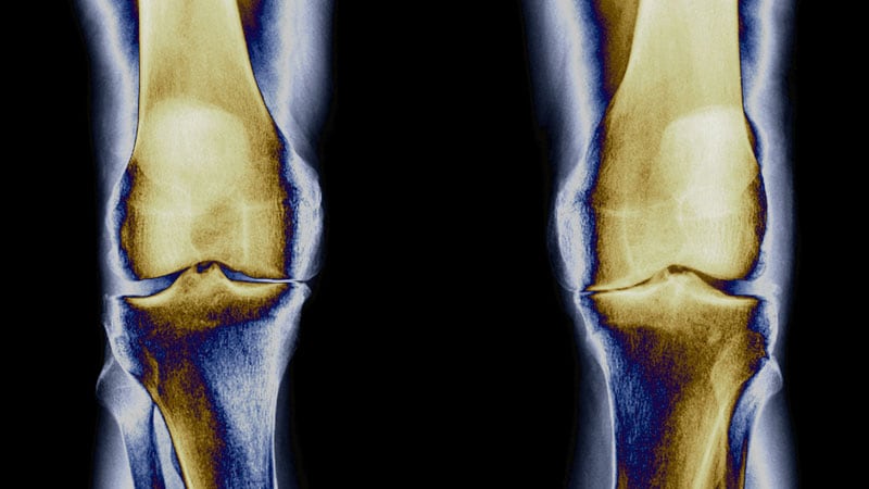 Blood Biomarkers Predict Knee OA Years in Advance