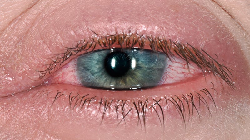 High Recurrence in Acute Uveitis Linked to Viral Causes thumbnail